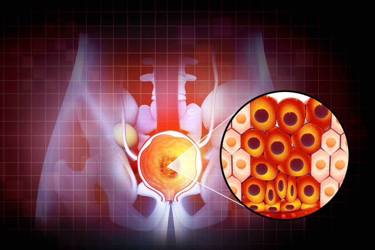 Benign Prostatic Hyperplasia (BPH)