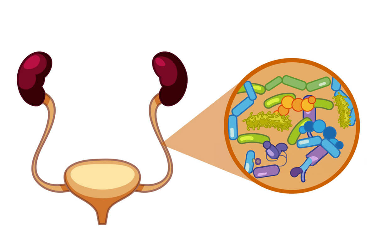 Urinary Tract Infection (UTI)