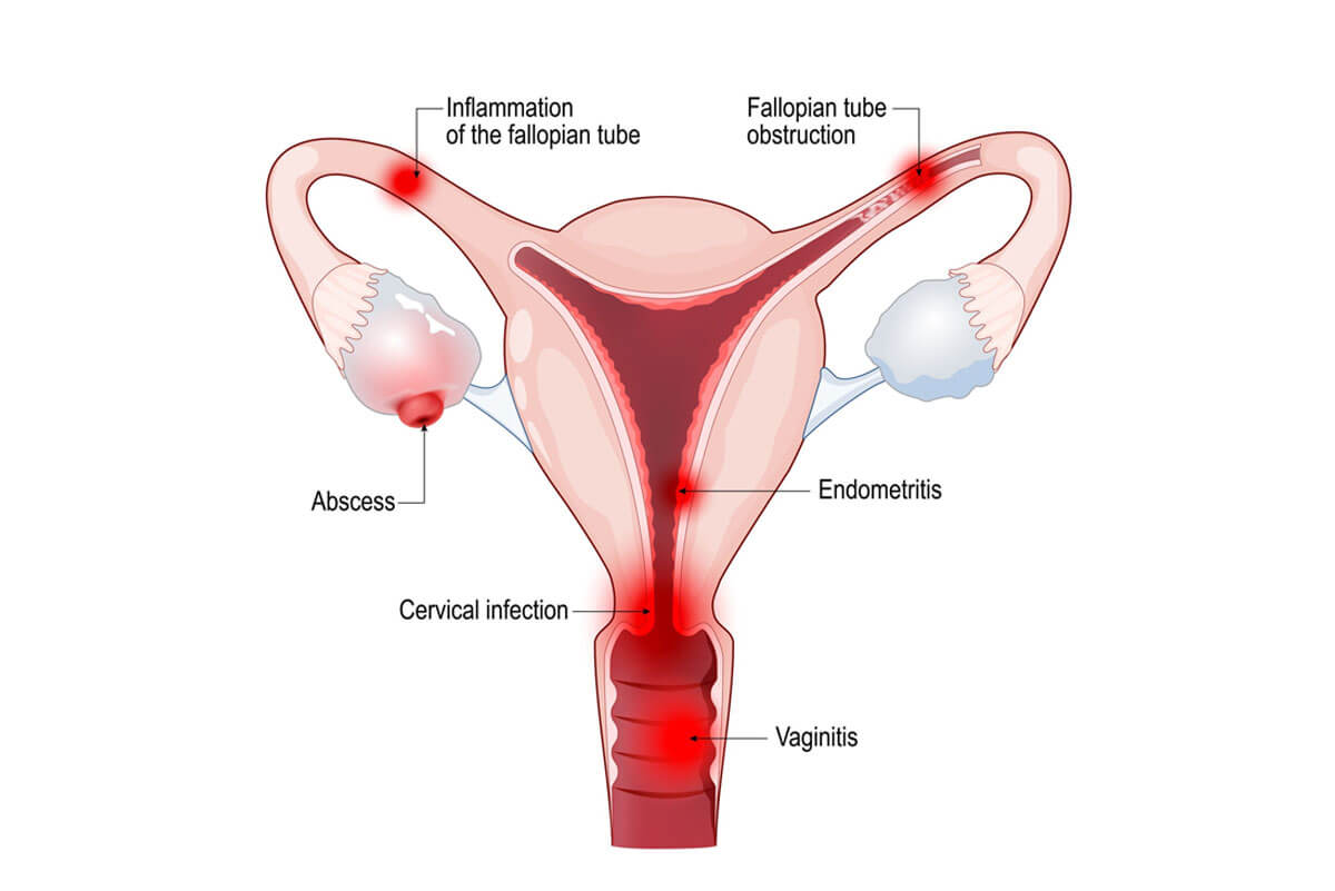 Pelvic Floor Disease