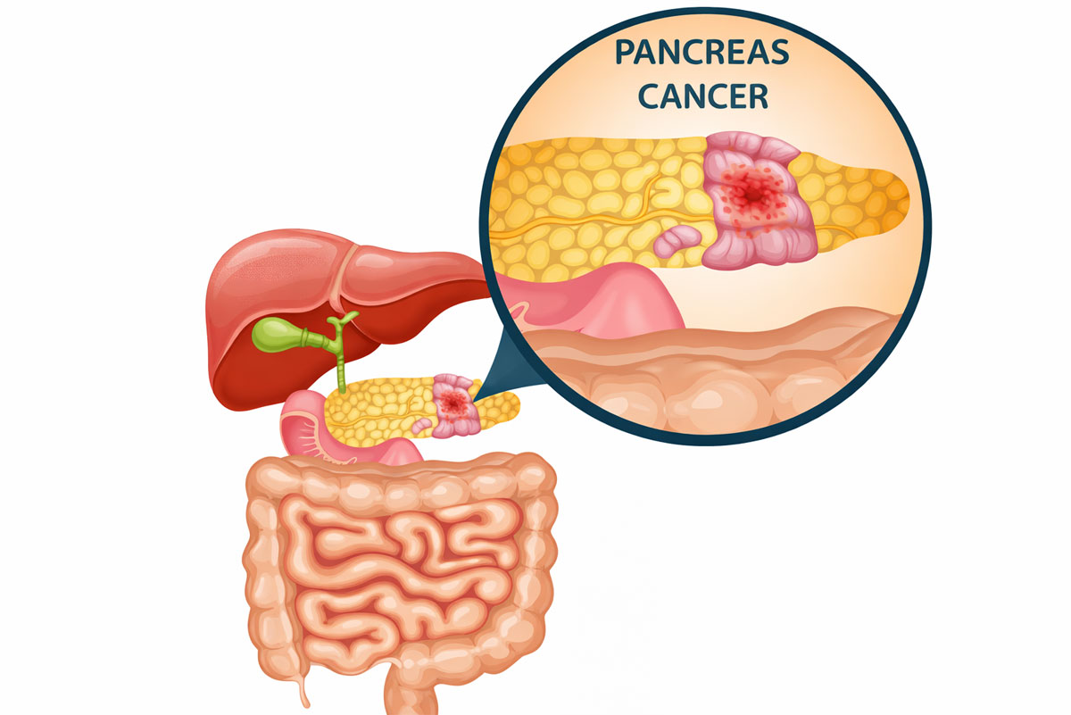 Pancreatic Cancer
