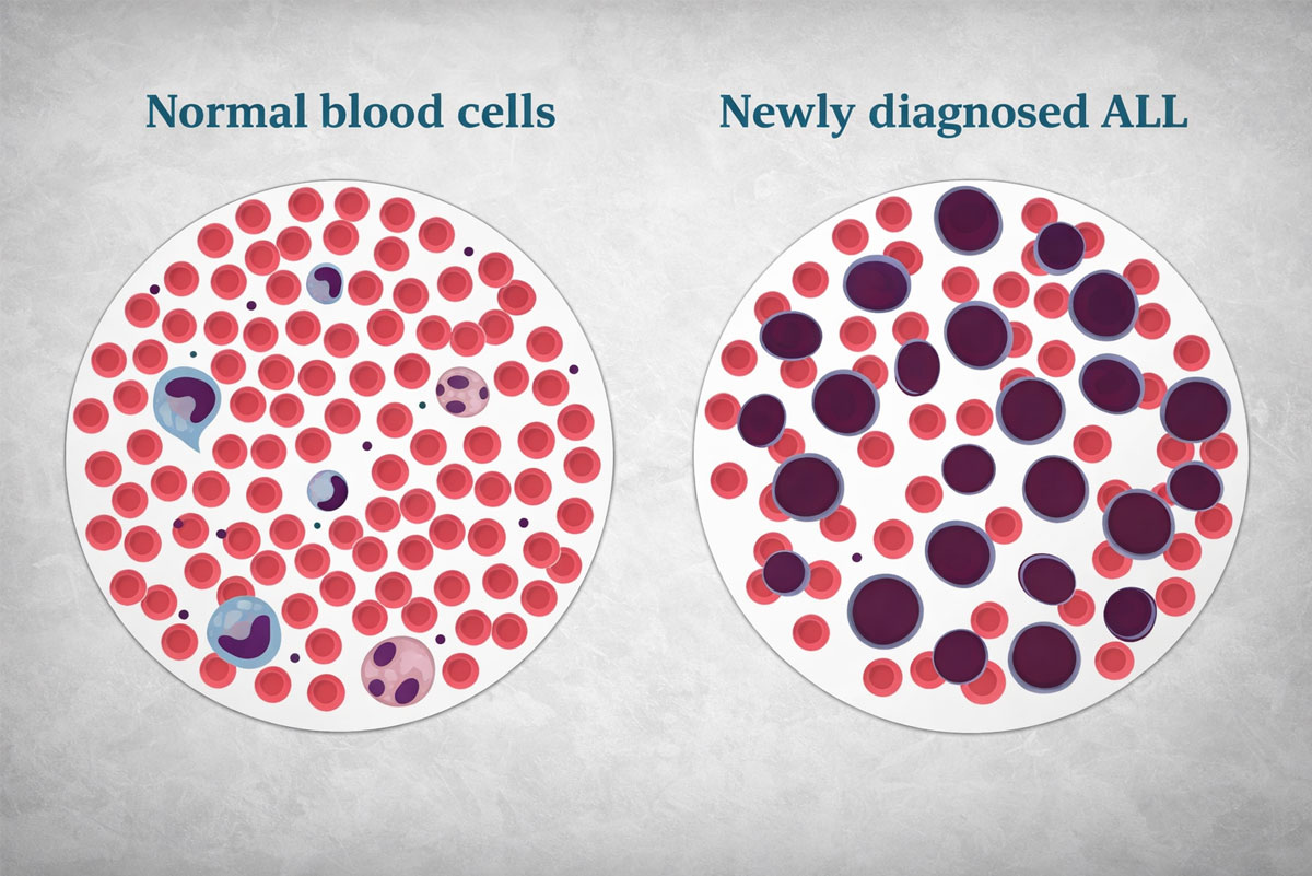 Acute Lymphoblastic Leukemia