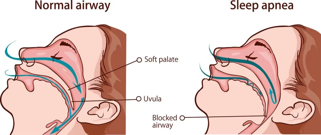 Sleep Apnea Syndrome